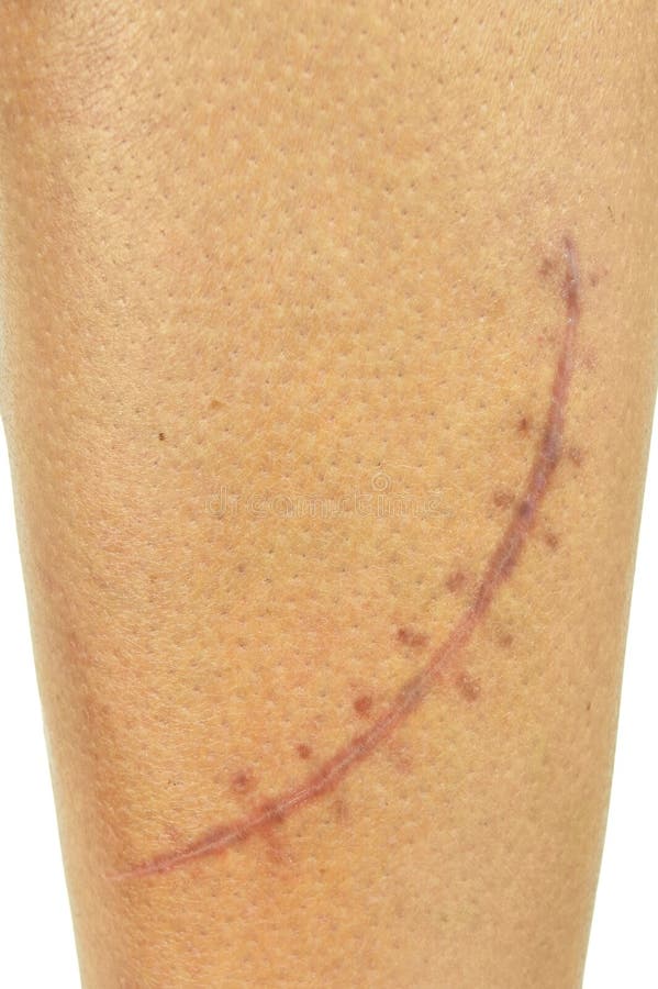 Scar with Stitches on the Wrist after Surgery. Fracture of the Bones of