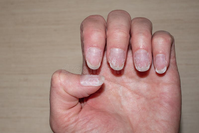 Peeling Nails: 8 Causes, Treatment, and Prevention