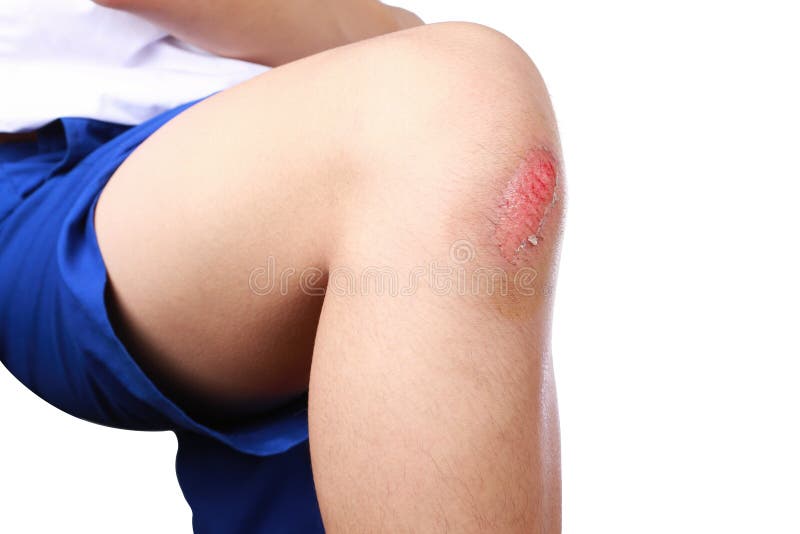 Close up of bleeding scraped after run accident isolated on white background royalty free stock images Close up of bleeding scraped after run accident isolated on white background royalty free stock images