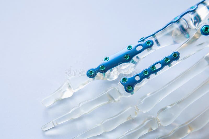 Close up a blue Locking plate is fixed on a crystal finger bone with screw on a white background stock photography