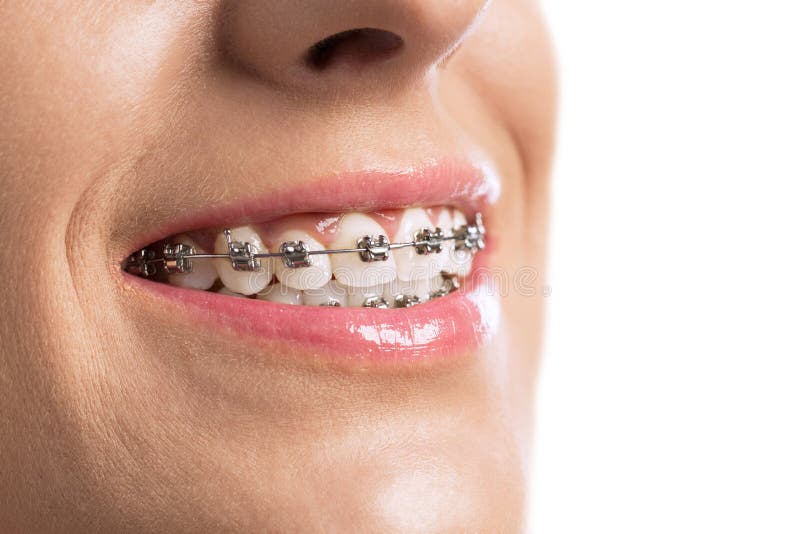 Close Up of Braces Girls Teeth Stock Image Image of heal, healthy
