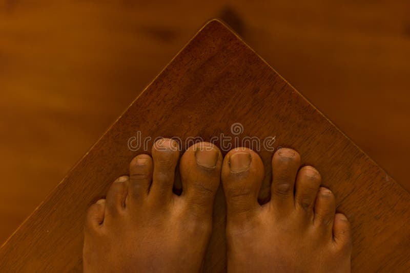 Mortons Toe Stock Photos - Free & Royalty-Free Stock Photos from Dreamstime