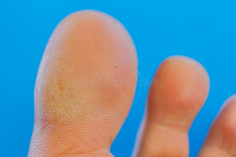 Close up of callus stock image. Image of barefoot, person 222404359
