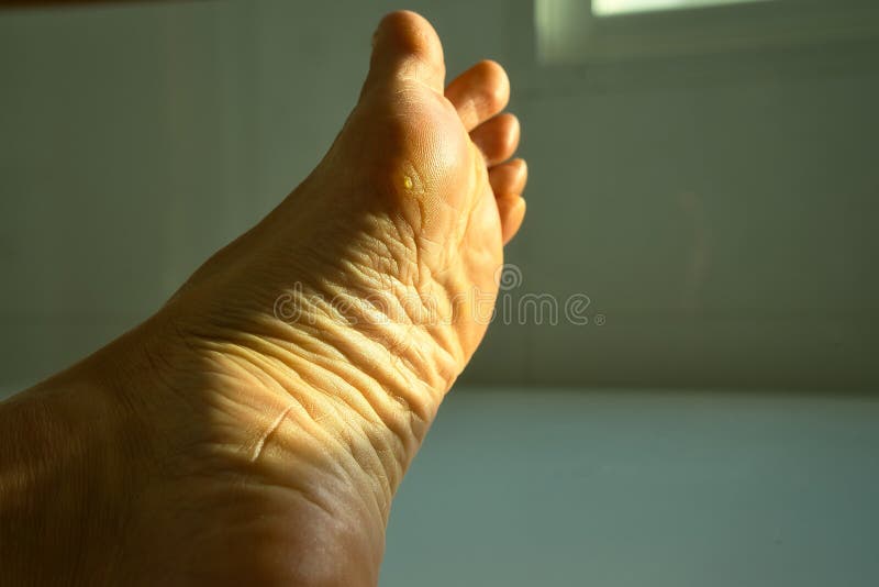 Closeup of Callus on the Sole of a Female Foot Stock Image Image of ache, pain 242503691