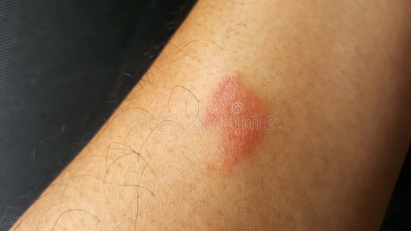 Close-up Centipede Bite, Poisonous Hurt Arm Stock Photo - Image of