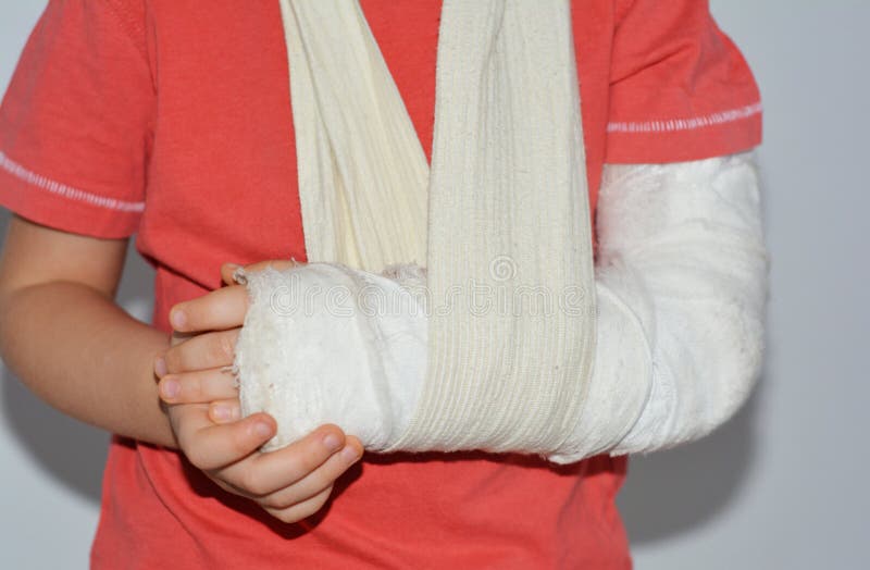 A close-up of a child a four year old boy with a broken arm in a cast for the immobilization of a broken bone stock photography.