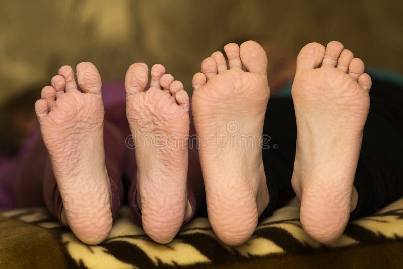 Wrinkled Soles Pics