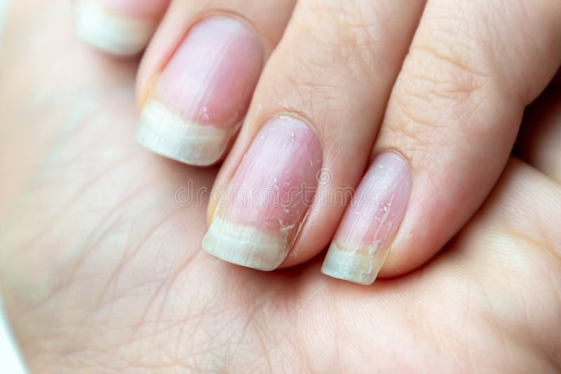 Close Up of Damaged Nails that Have Problem after Doing Manicure. Health and Beauty Problem Stock Photo - Image of external, careless: 153809904 Close Up of Damaged Nails that Have Problem after Doing Manicure. Health and Beauty Problem Stock Photo - Image of external, careless: 153809904