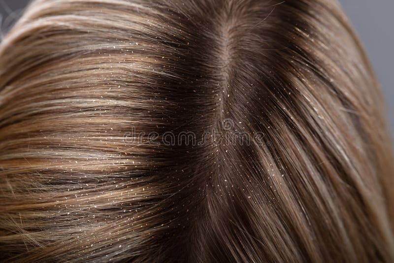 Dandruff in Woman`s Hair stock image. Image of discomfort - 149003425