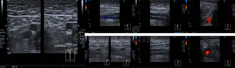 Close up Doppler Ultrasound of Deep Vein Thrombosis Superficial Femoral Vein compress legs Medical healthcare concept