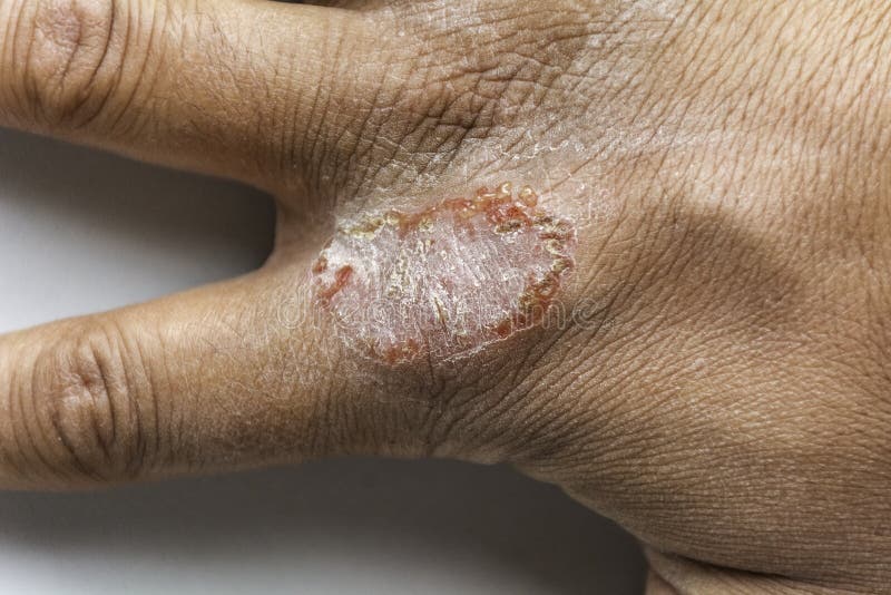 Hand with Atopic Dermatitis Eczema Psoriasis Vulgaris Stock Photo
