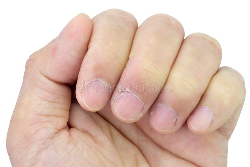 103 Dry Cuticles Stock Photos - Free & Royalty-Free Stock Photos from  Dreamstime