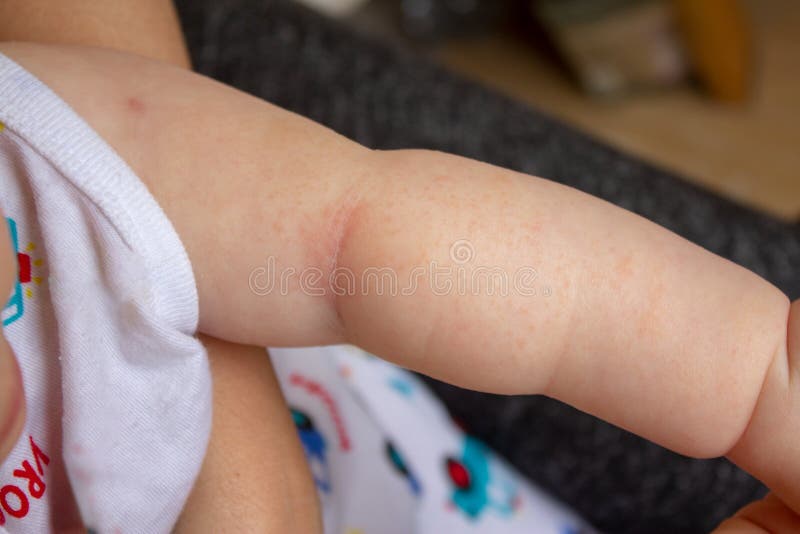 685 Heat Rash Stock Photos - Free & Royalty-Free Stock Photos from  Dreamstime