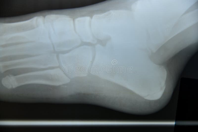 X ray Foot Bone Fracture Base Of Metatarsal Fracture From Traumatic