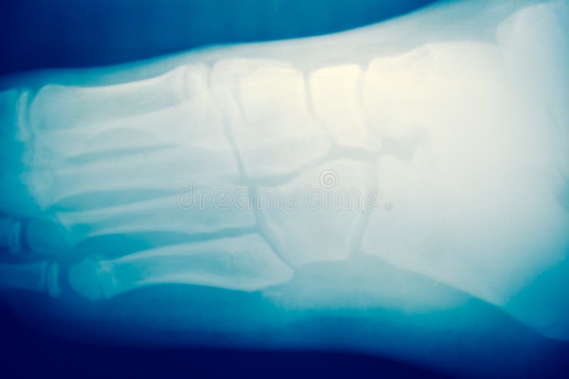 X ray Foot Bone Fracture Base of Metatarsal Fracture from Traumatic
