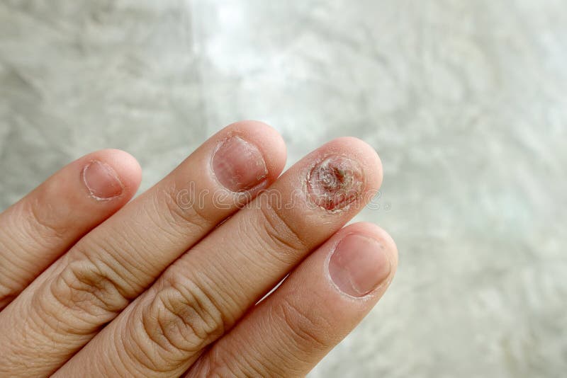 Close Up of Fungus Nail Infection. Fungal Infection on Nails Hand, Finger  with Onychomycosis, Damage on Human Hand on Gray Stock Photo - Image of  dome, discolored: 164240316
