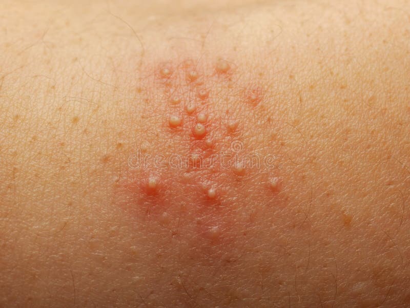 Rash and other nonspecific skin eruption