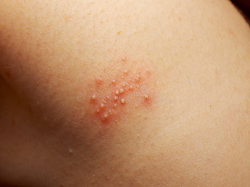 Rash and other nonspecific skin eruption