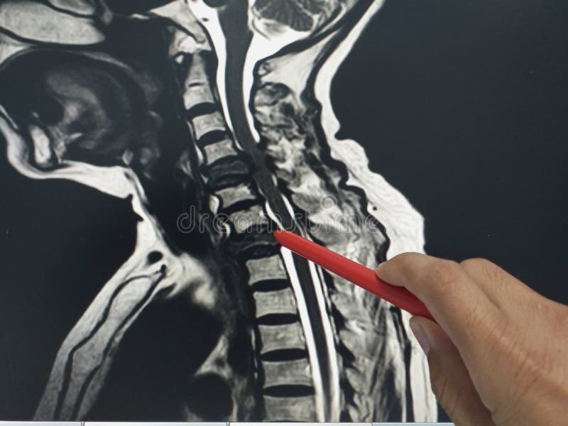 Close up hand doctor holding a red pen tells the patient the examination of the mri c-spine. royalty free stock photo Close up hand doctor holding a red pen tells the patient the examination of the mri c-spine. royalty free stock photo