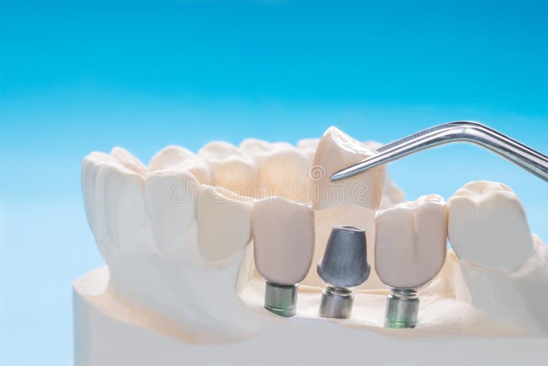 Close Up Implant and Prosthodontic Model. Stock Image Image of medicine, prosthodontic 154475751