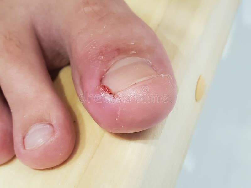 Close-up of an Inflamed Big Toe with an Ingrown Nail and Pus Stock Photo -  Image of care, macro: 171297822
