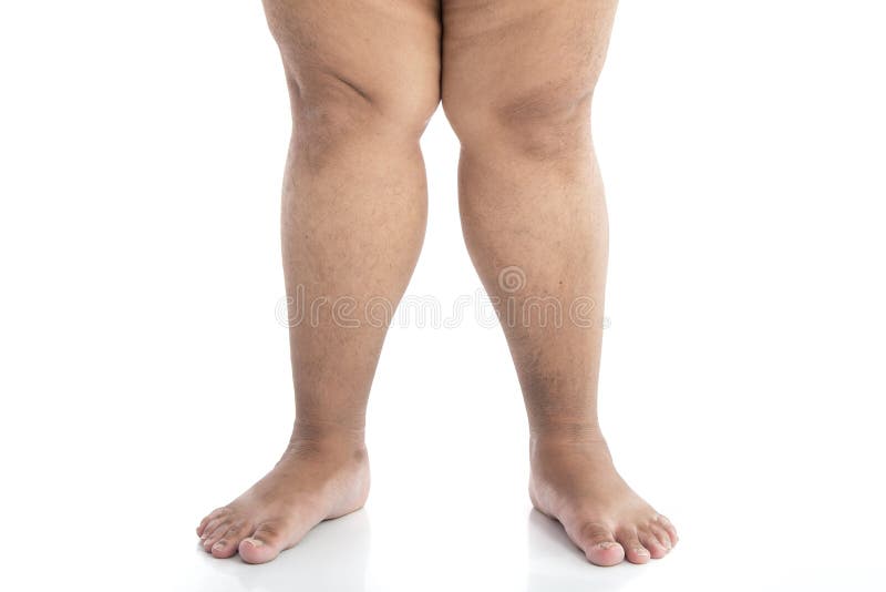Close Up Legs Overweight Standing Stock Photos Free & RoyaltyFree