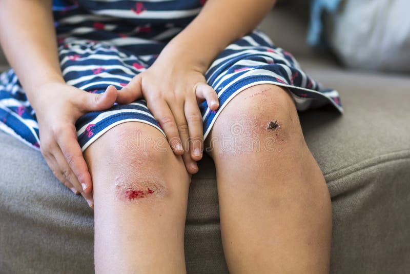 Close-up of little girl holding her bruised injured damaged knee royalty free stock image Close-up of little girl holding her bruised injured damaged knee royalty free stock image