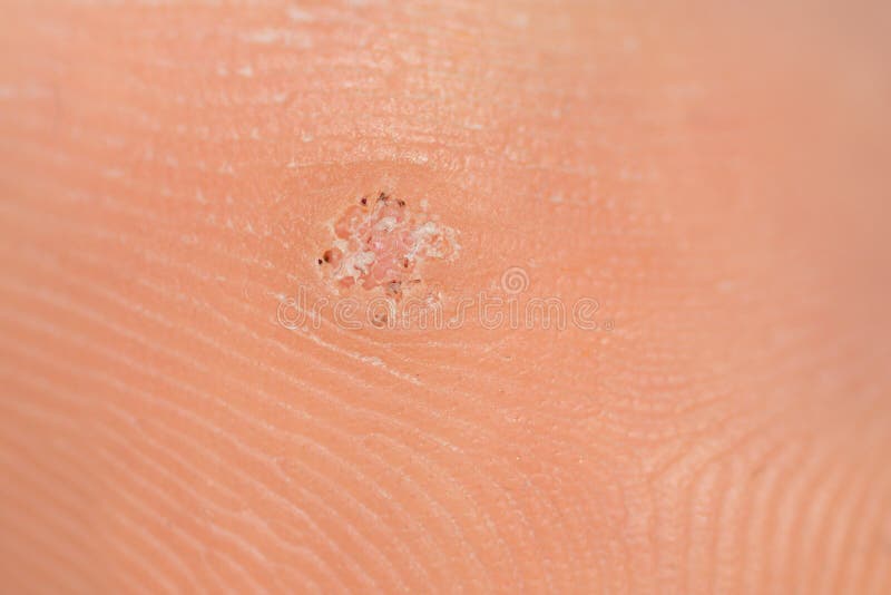 Warts on your foot Wart causing foot pain