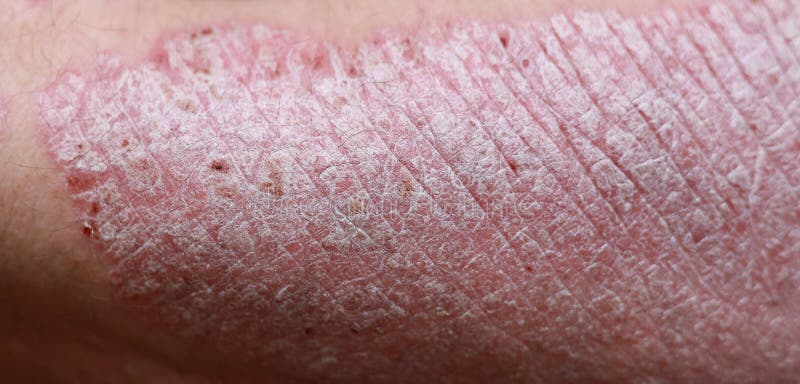 Close Up Macro Of Psoriasis Skin Autoimmune Disease That Affects The