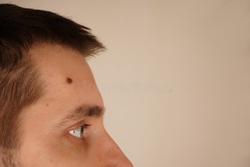 A close-up of a man& x27;s forehead and eyes, showcasing a visible mole on the side. The natural expression highlights stock photo