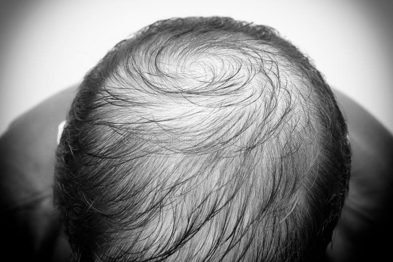 Close Up Man`s Head with Hair Loss, Thinning Hair or Alopecia Isolated on White Background. Black and White Tone Stock Photo - Image of loss, background: 193045096 Close Up Man`s Head with Hair Loss, Thinning Hair or Alopecia Isolated on White Background. Black and White Tone Stock Photo - Image of loss, background: 193045096