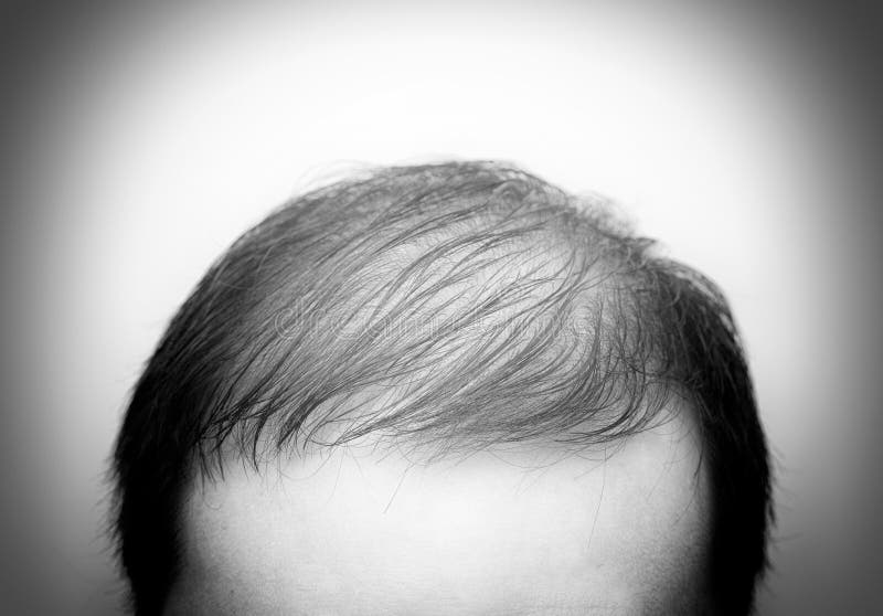 Close Up Man`s Head with Hair Loss, Thinning Hair or Alopecia Isolated on White Background. Hair Problem Stock Image - Image of illness, asian: 193045035 Close Up Man`s Head with Hair Loss, Thinning Hair or Alopecia Isolated on White Background. Hair Problem Stock Image - Image of illness, asian: 193045035