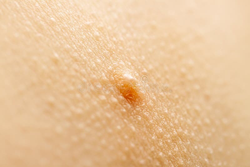 Close Up of Molluscum Contagiosum Also Called Water Wart Stock Photo