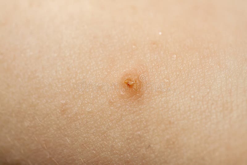 Close Up of Molluscum Contagiosum Also Called Water Wart Stock Photo