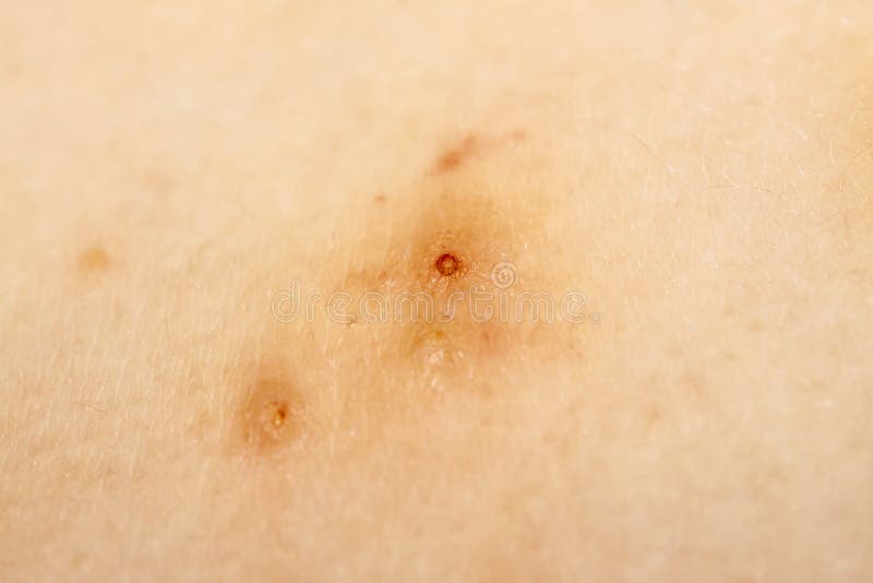 Close Up of Molluscum Contagiosum Also Called Water Wart Stock Photo