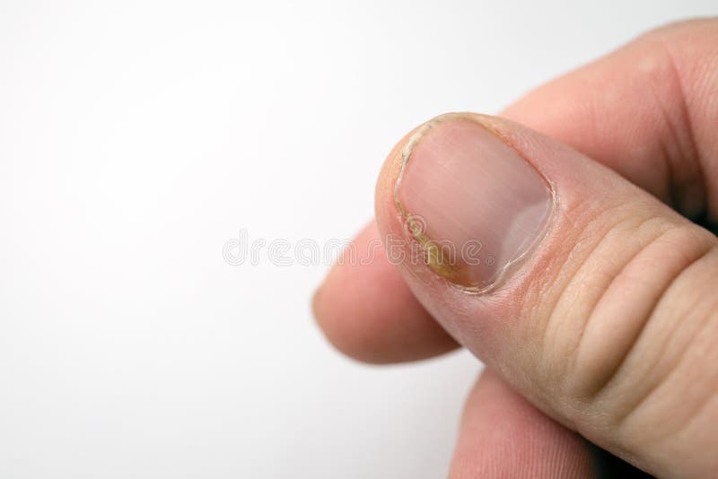 Big close up of fungus Infection on Nails Hand, Finger with onychomycosis,  Fungal infection on nails. - Stock Image - Everypixel