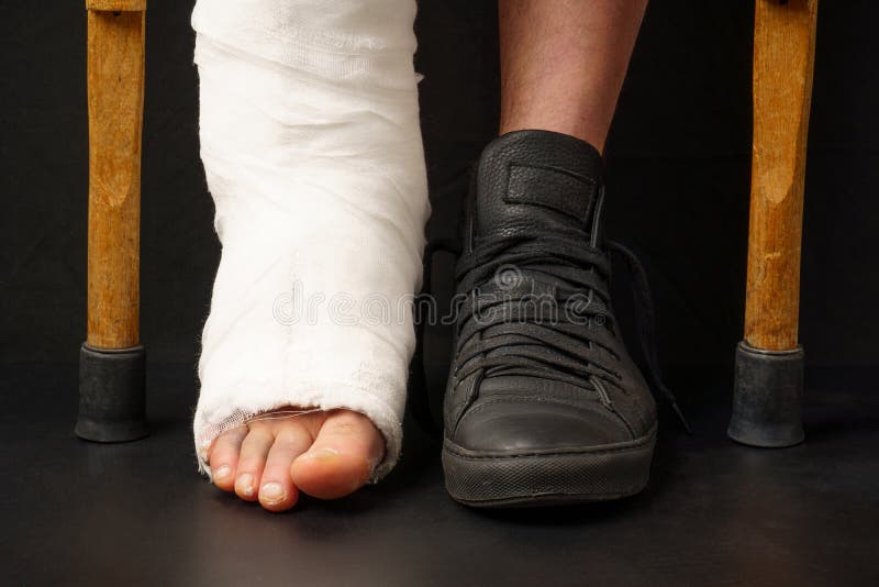 Closeup of One Broken Leg, in a Cast, the Second is Shod in a Winter