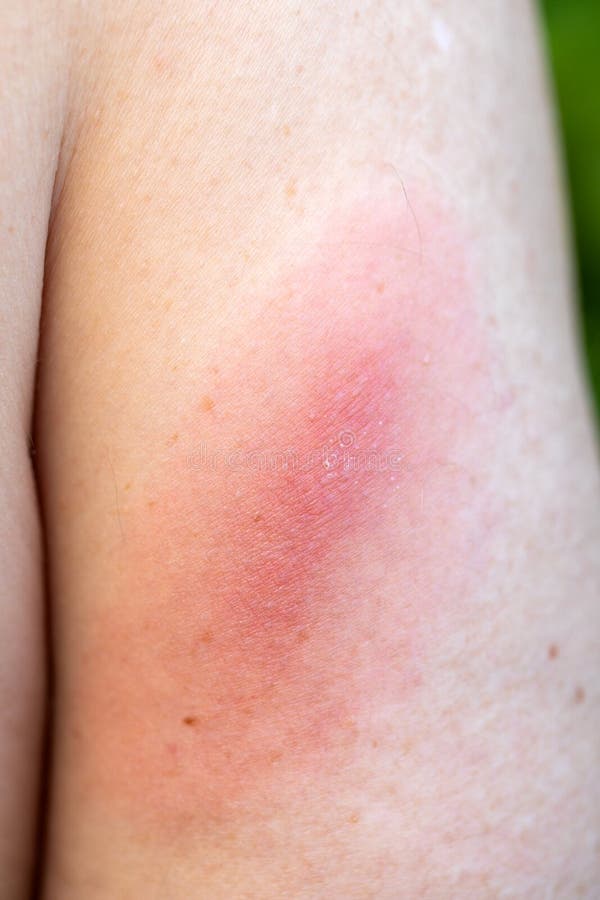 Close up picture of lyme spot on human skin - borrelia, lyme disease caused by tick ixodes ricinus