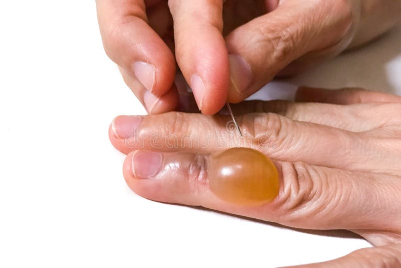 Blood blister stock image. Image of finger, person, skin - 34687531