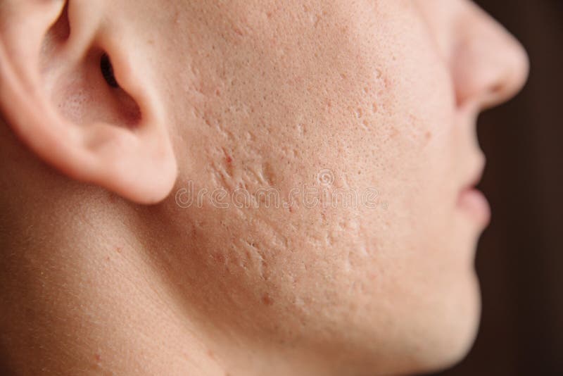 Close-up of problem skin with deep acne scars on a young man`s cheek. Problem wrinkle stock images, royalty-free photos and pictures