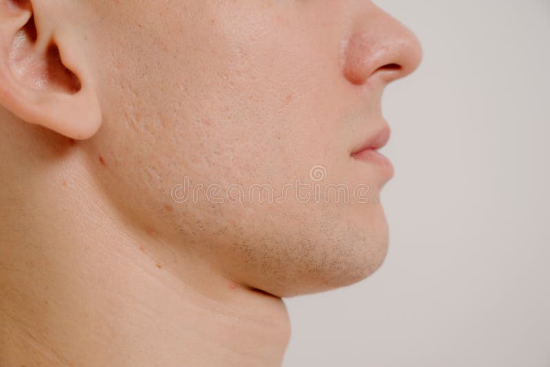 Acne scars on the face stock image. Image of acne, melasma 243187009
