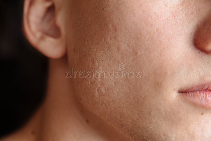 facial for acne scars near me