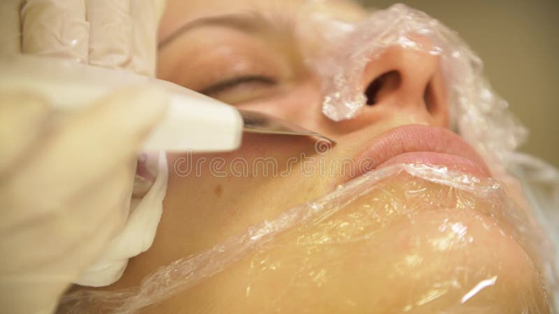 Close up procedure laser removal of black dots from the skin of a young woman in a cosmetic clinic.