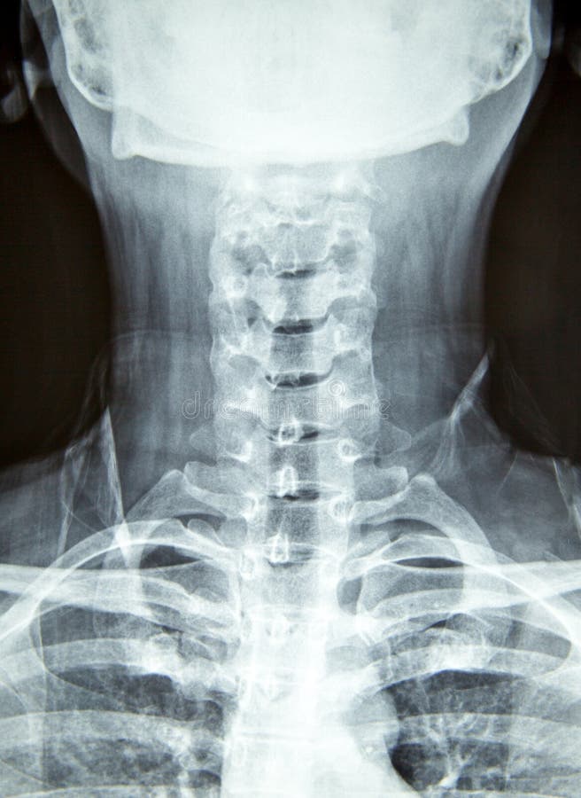 Close Up X-ray Film Show Cervical Spine or C-spine, Neck Bones X-ray ...
