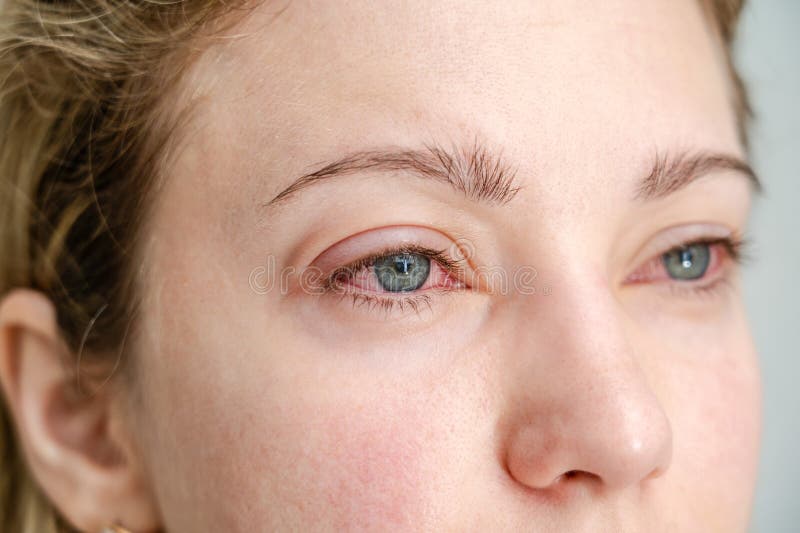 Close Up of Red Irritated Human Eyes, Allergy Symptom, Conjunctivitis