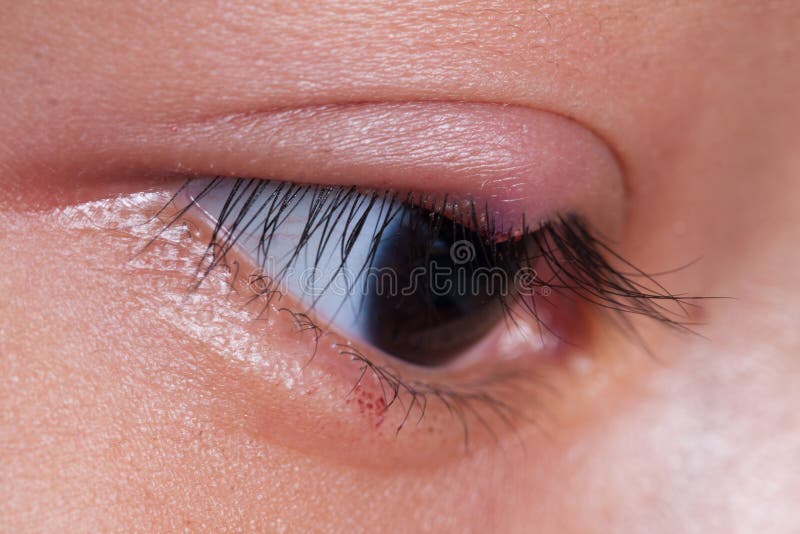 Close Up Right Upper Eye Lid Abscess Stock Image Image of eyelid, abscess 72752693
