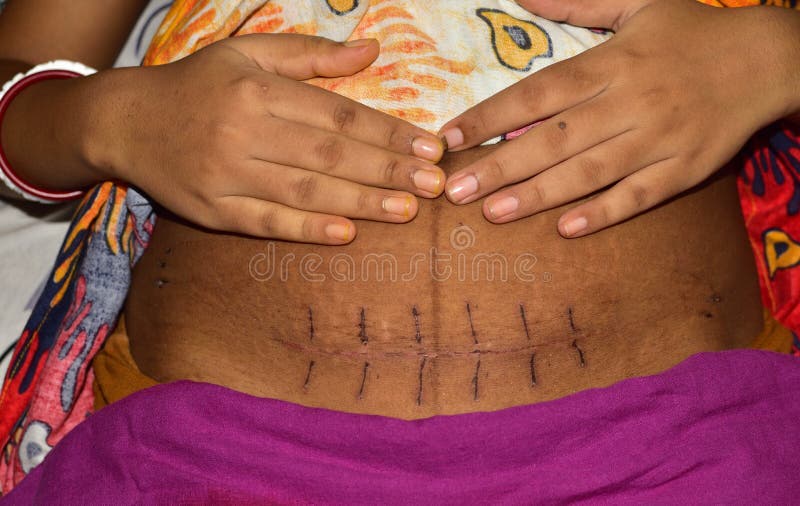 cesarean scar after 1 year