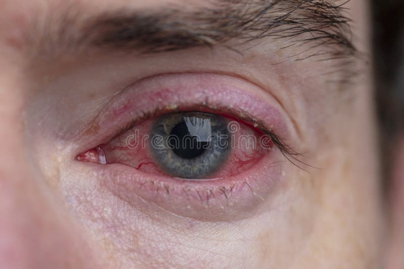 Close Up Of A Severe Bloodshot Eye. Blepharitis, Conjunctivitis