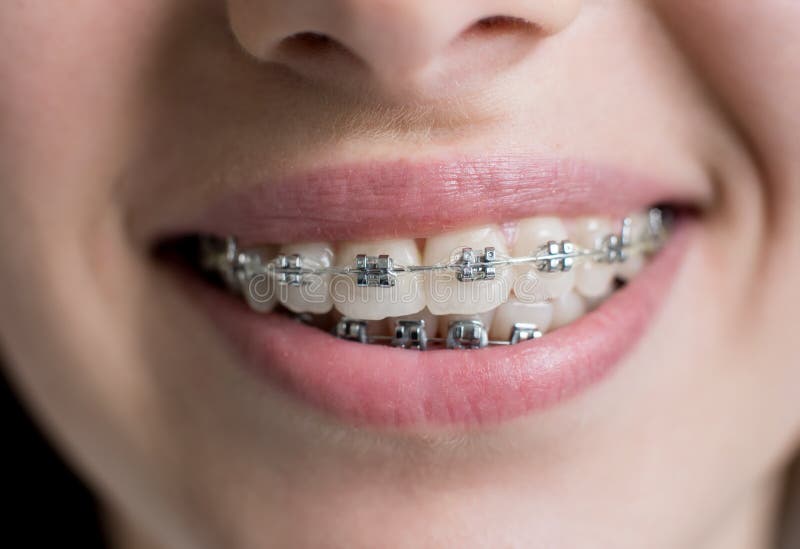 Close-up shot of teeth with braces. Female patient with metal brackets at the dental office. Orthodontic Treatment stock photos Close-up shot of teeth with braces. Female patient with metal brackets at the dental office. Orthodontic Treatment stock photos