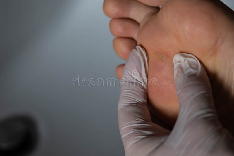 Close up shot of a warty Caucasian man`s foot.